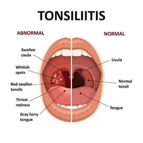 Schema einer Tonsillitis: entzündete Mandeln im hinteren Rachenbereich