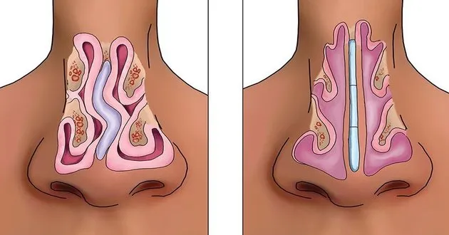 Septoplasty: surgical correction of a deviated nasal septum