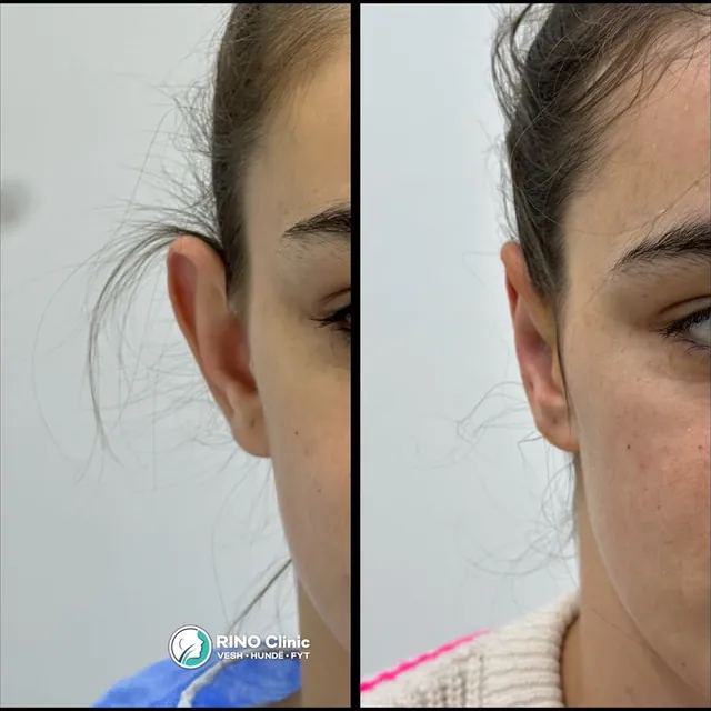 Otoplastikë, rasti 7: para dhe pas ndërhyrjes