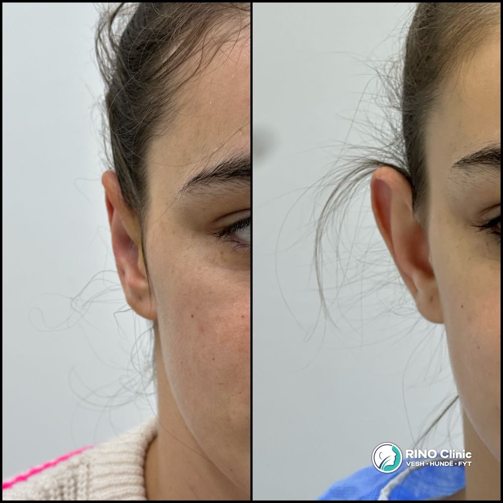 Otoplasty, before/after result, photo 7