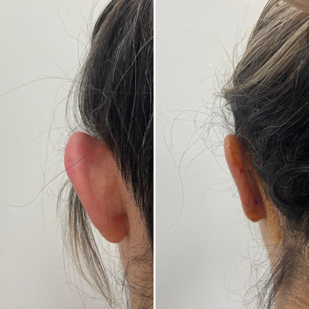 Otoplasty, before/after result, photo 6