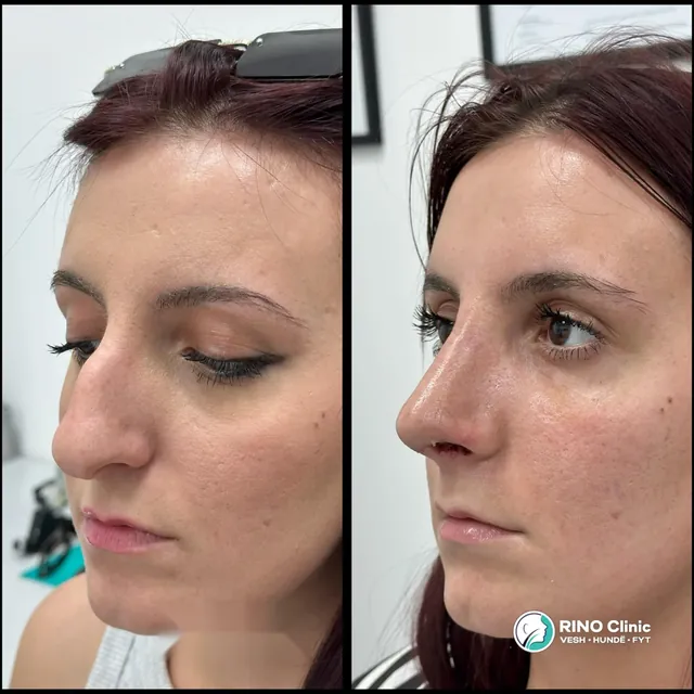 Rhinoplasty, case 3: before and after the procedure