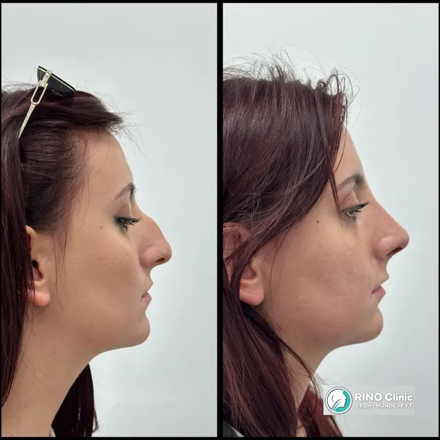 Rhinoplasty, case 1: before and after the procedure