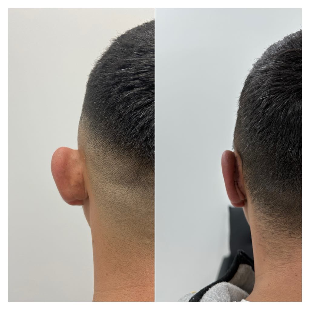 Otoplasty, before/after result, photo 4