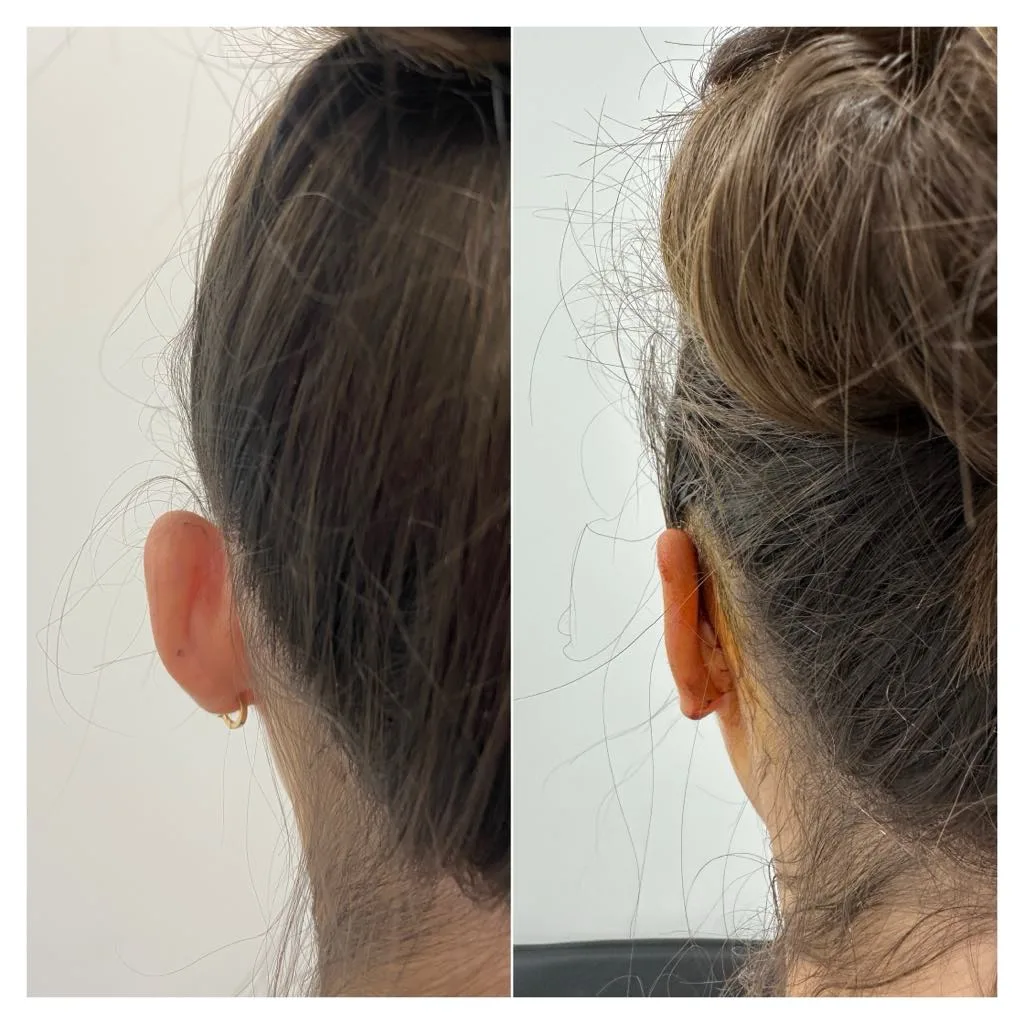 Otoplasty, before/after result, photo 5