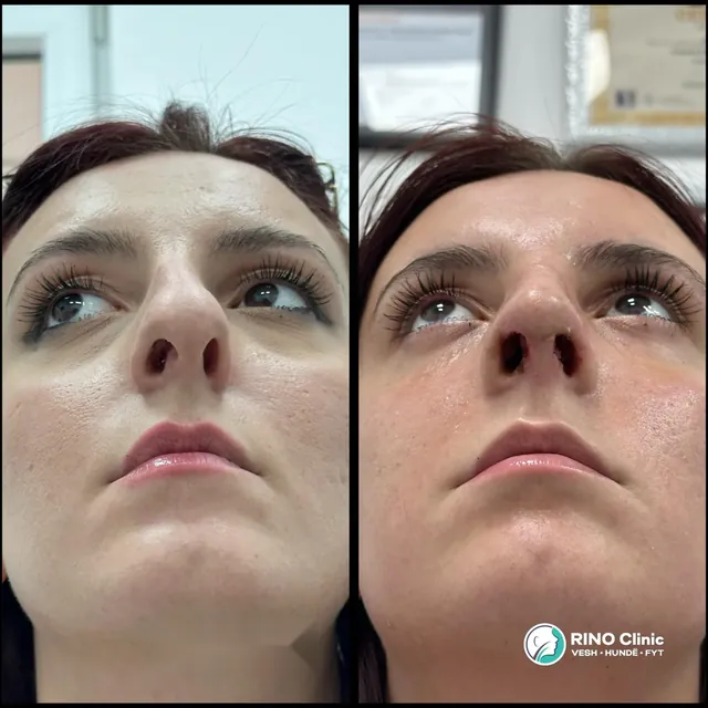 Rhinoplasty, case 2: before and after the procedure