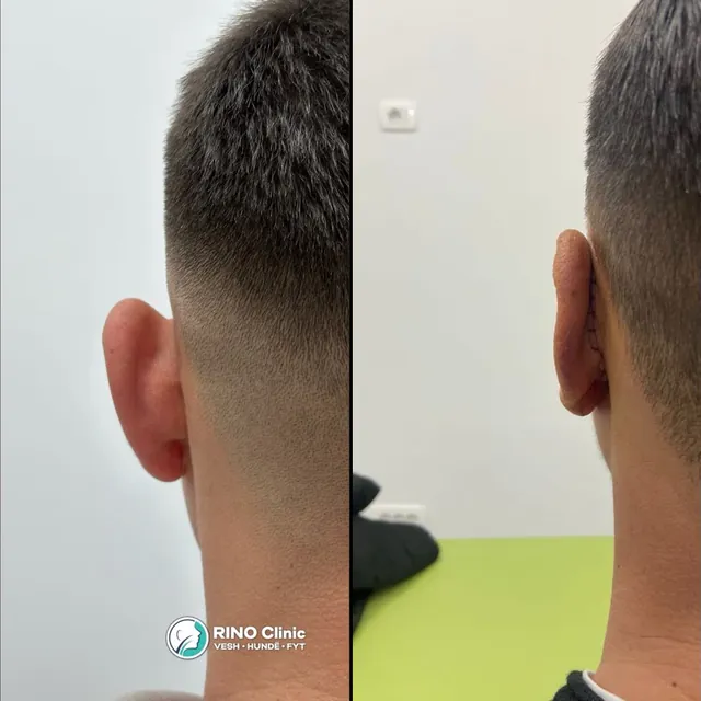Otoplastikë, rasti 1: para dhe pas ndërhyrjes