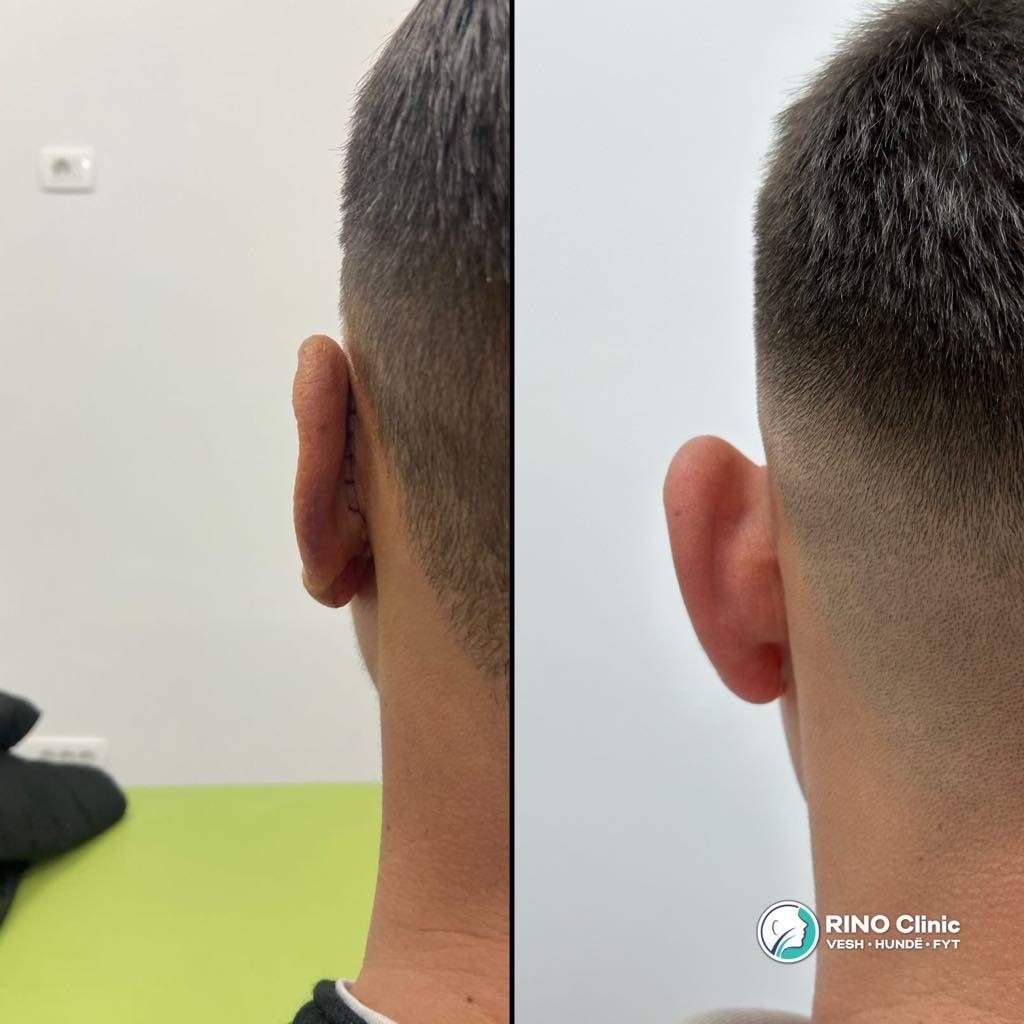 Otoplasty, before/after result, photo 1