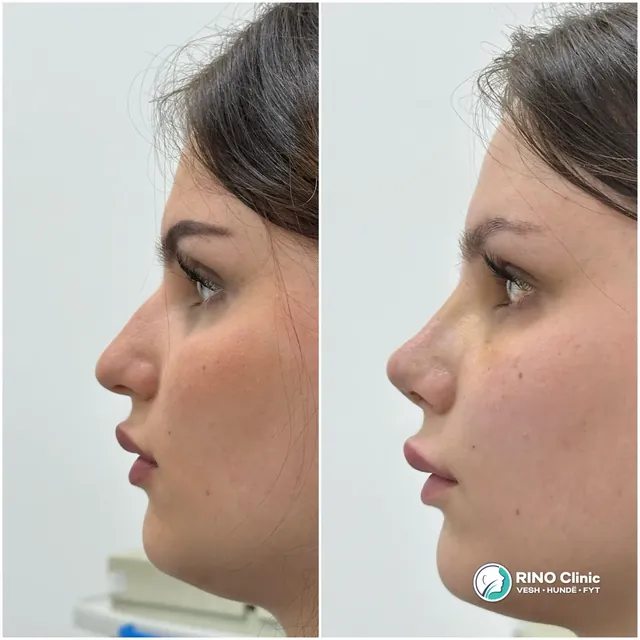 Rhinoplasty, case 5: before and after the procedure