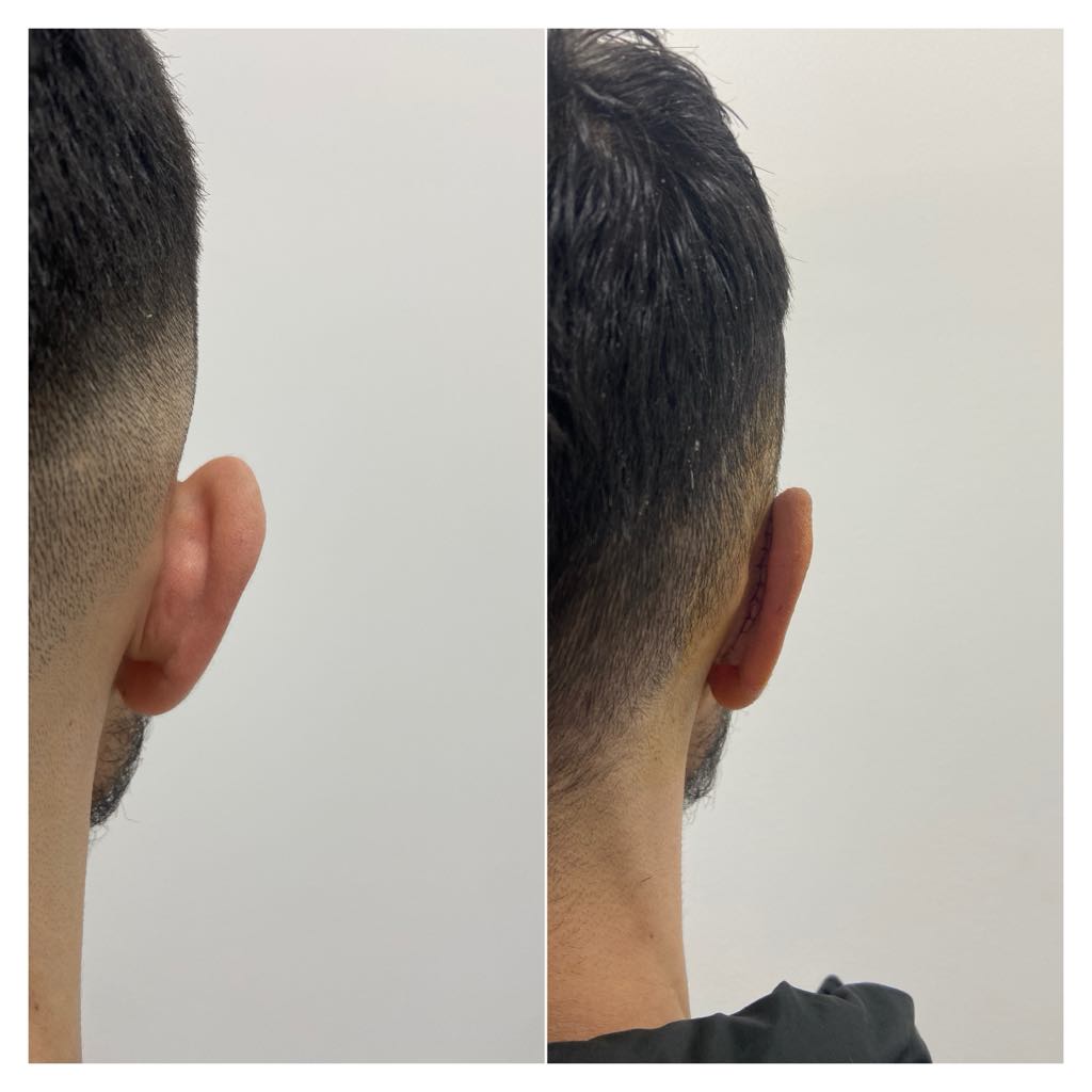 Otoplasty, before/after result, photo 2