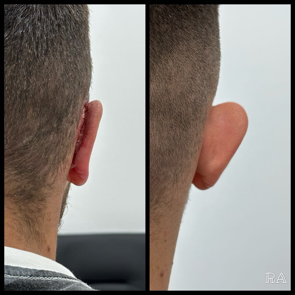 Otoplasty, before/after result, photo 3