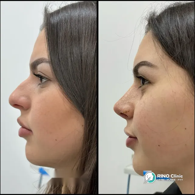 Rhinoplasty, case 4: before and after the procedure