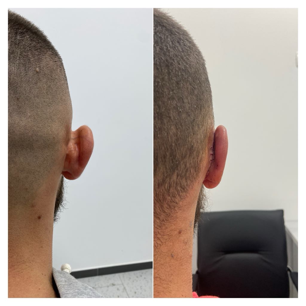 Otoplasty, before/after result, photo 8