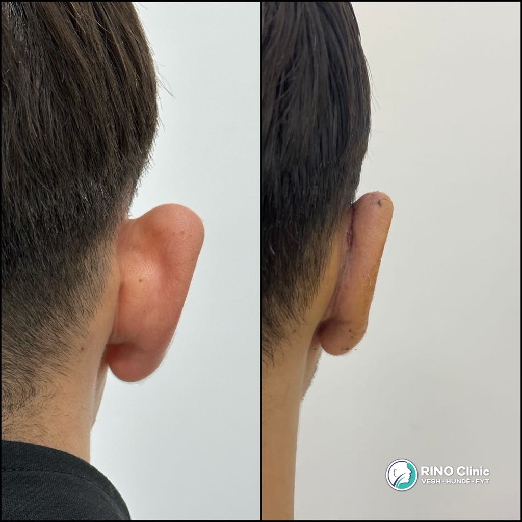 Otoplasty, before/after result, photo 11