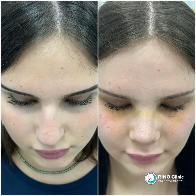 Rhinoplasty, case 6: before and after the procedure