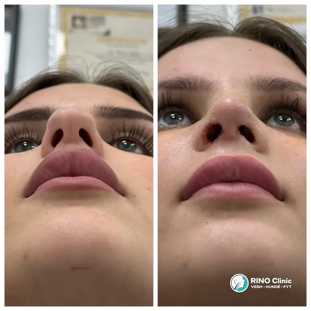 Rhinoplasty, case 7: before and after the procedure