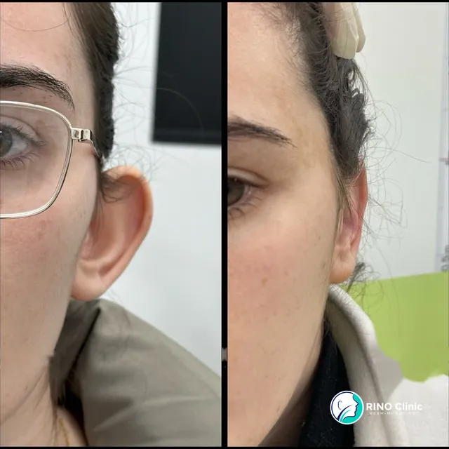 Otoplastikë, rasti 12: para dhe pas ndërhyrjes