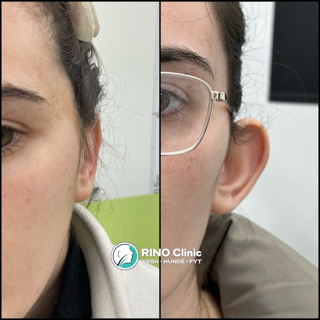 Otoplasty, before/after result, photo 12