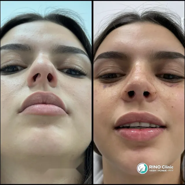 Rhinoplasty, case 8: before and after the procedure