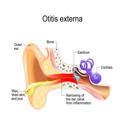 Schwimmerohr (Otitis externa): entzündeter Gehörgang