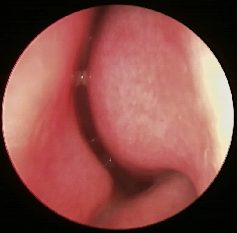 before the radiofrequency procedure
