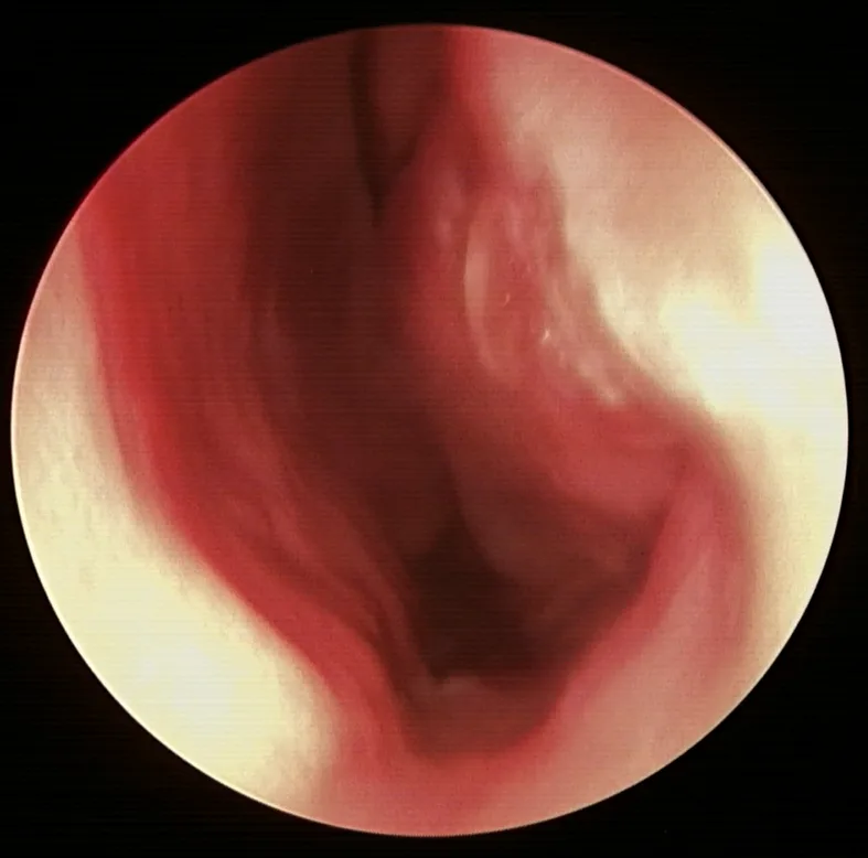 after the radiofrequency procedure