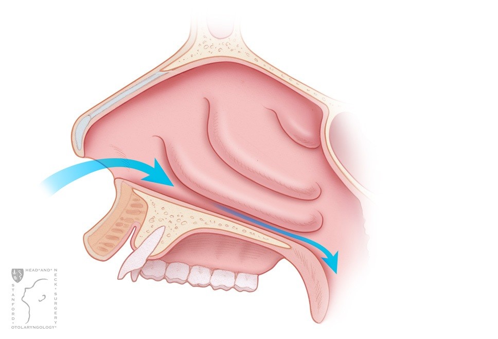 View of the nasal turbinates before and after radiofrequency treatment