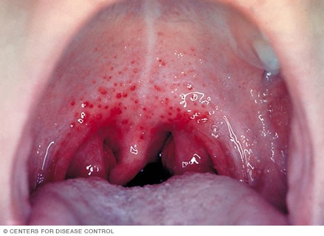 strep throat