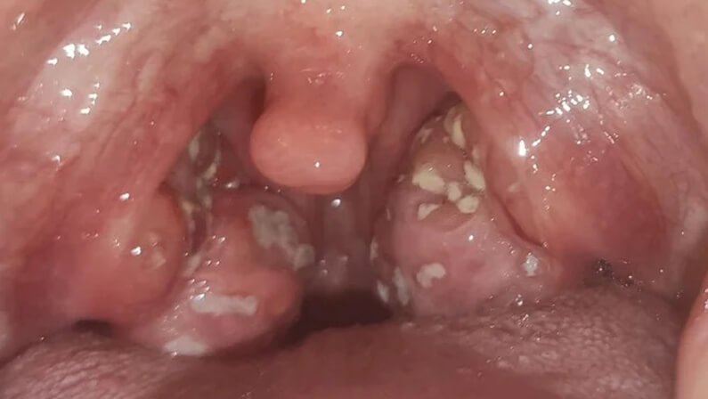 acute tonsillitis